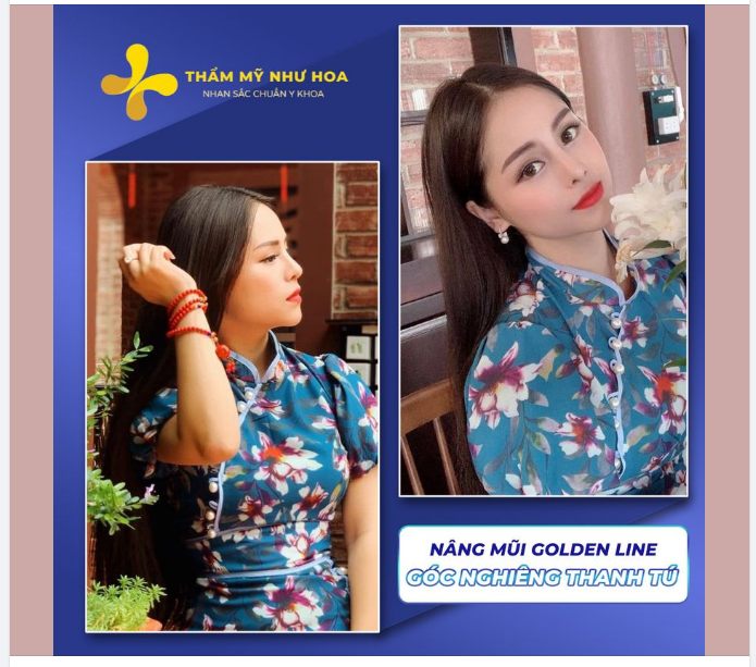 Góc nghiêng của khách hàng đã thay đổi như thế nào sau nâng mũi Golden Line?