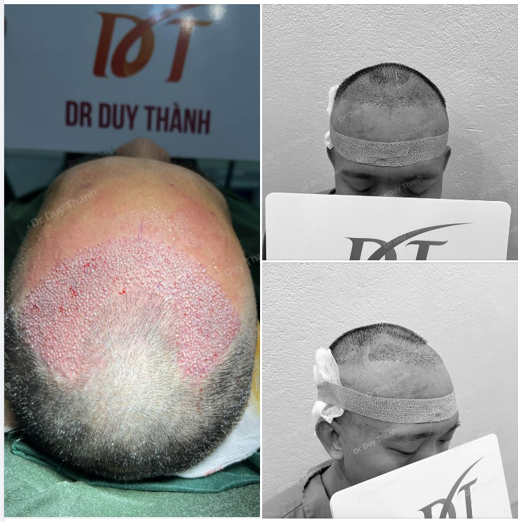 TRẢ KẾT QUẢ NGAY SAU CẤY 1600 NANG TÓC, KHÁCH NAM 30 TUỔI