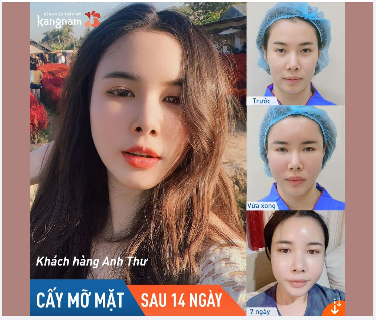 Chị khách Anh Thư trẻ đẹp bất ngờ sau 14 ngày cấy mỡ toàn mặt