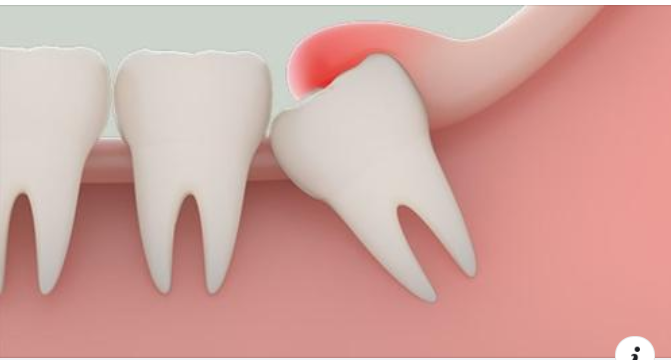 Nguyên nhân và hậu quả khi sâu răng số 8? Sâu răng số 8 nên làm gì?