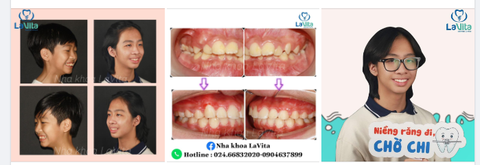 THÁO NIỀNG CHO BẠN KHÁCH HÀNG 14 TUỔI TẠI NHA KHOA LAVITA