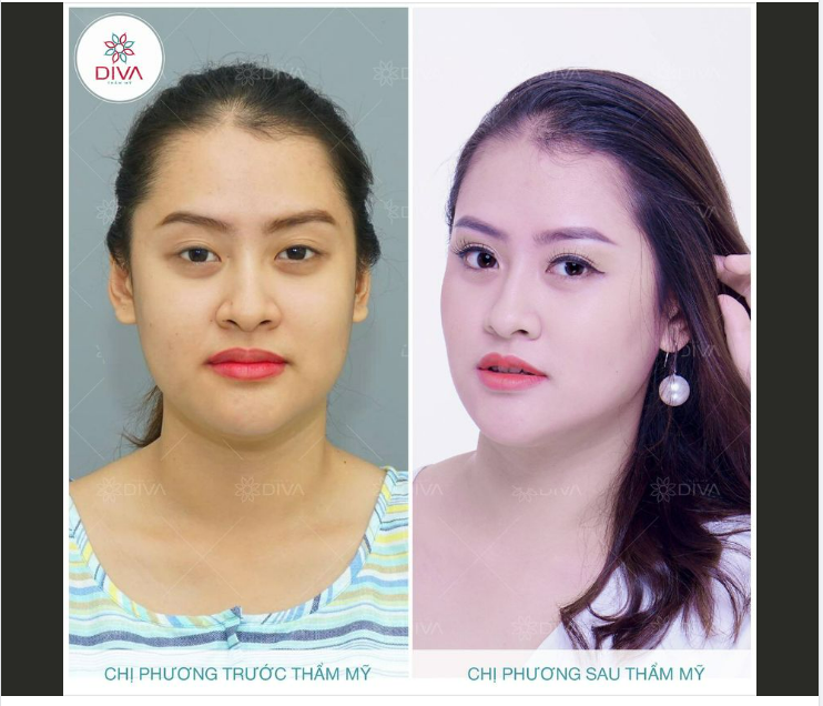 PHƯƠNG PHÁP TÁCH TÚI MỠ MÁ TRONG ĐƠN GIẢN HAY PHỨC TẠP?