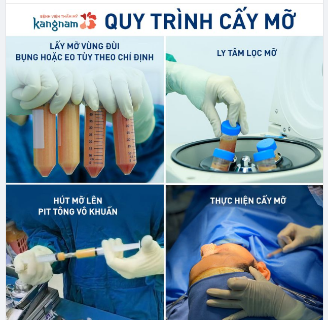 Chuẩn quy trình cấy mỡ an toàn - hiệu quả tại kangnam