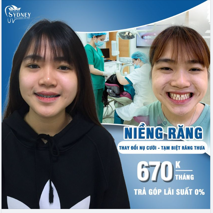 Niềng mắc cài kim loại thay đổi nụ cười – An toàn mà hiệu quả