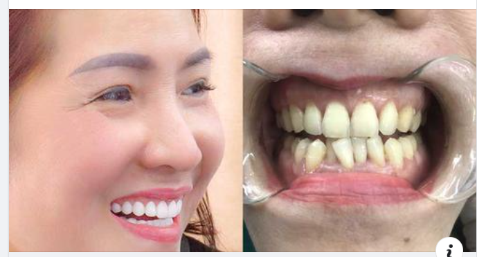 Cách Chăm Sóc Để Răng Sứ Tồn Tại Lâu Dài Hơn