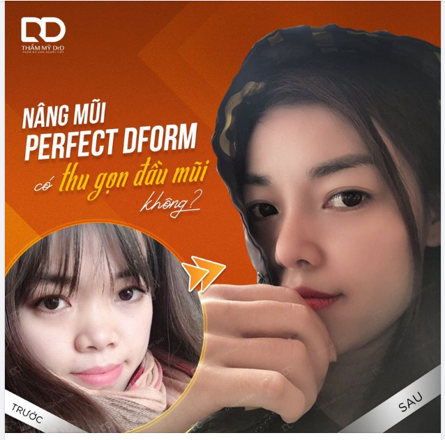 NÂNG MŨI PERFECT DFORM CÓ THU GỌN ĐẦU MŨI?