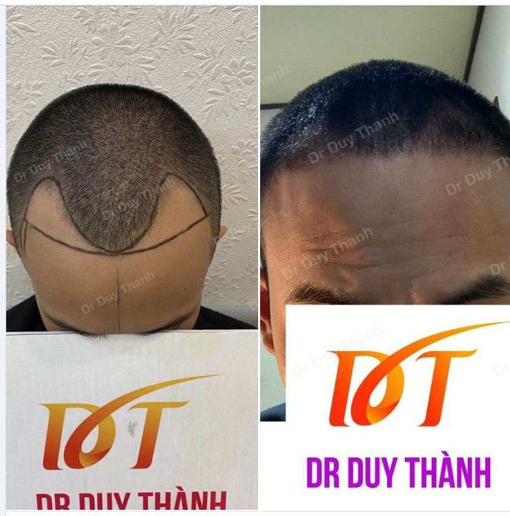 3 THÁNG 15 NGÀY SAU CẤY 1300 NANG TÓC