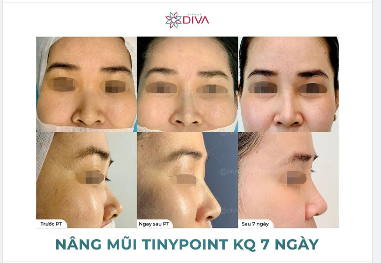 KẾT QUẢ SAU 7 NGÀY NÂNG MŨI TINY POINT