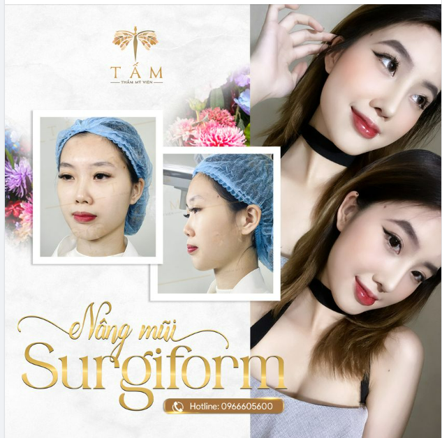 Ngất người với nhan sắc của khách hàng được hoàn thiện vô cùng tự nhiên nhờ nâng mũi Surgiform