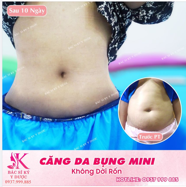 CĂNG DA BỤNG MINI KHÔNG DỜI RỐN