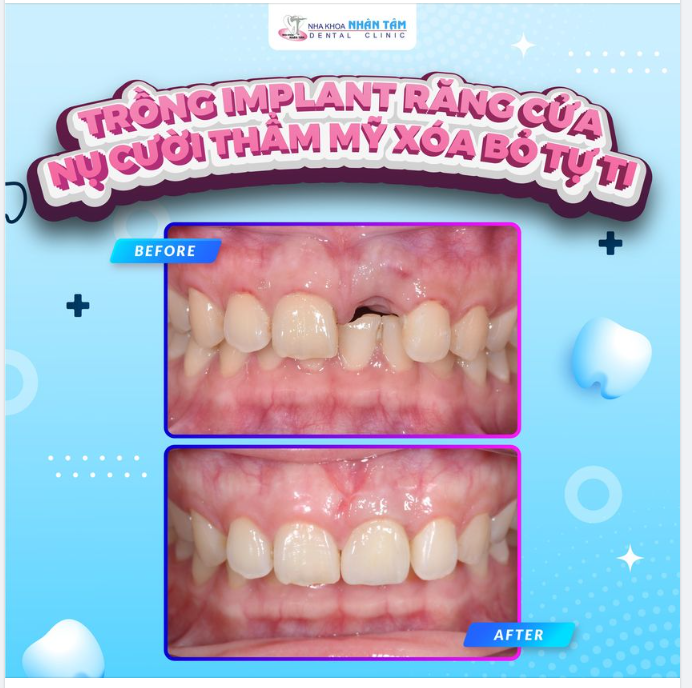 Trồng implant răng cửa - Nụ cười thẩm mỹ xoá bỏ tự ti