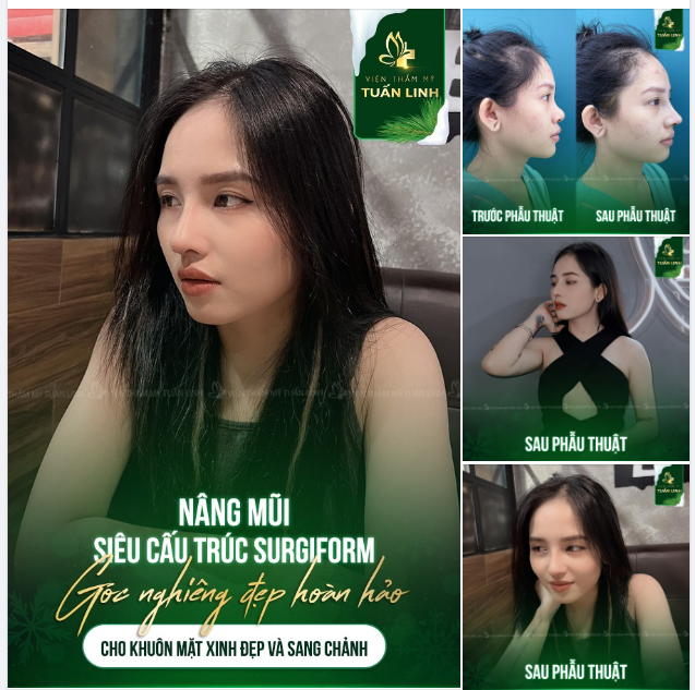 Hình ảnh cô nàng L.H thực hiện nâng mũi siêu cấu trúc Surgiform tại Tuấn Linh đã chứng minh điều đó. Click xem ngay pic bên dưới nha.