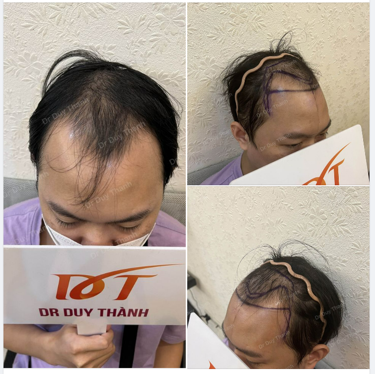 CHUẨN BỊ CẤY 2000 NANG TÓC, BOY 29 TUỔI BẮC NINH
