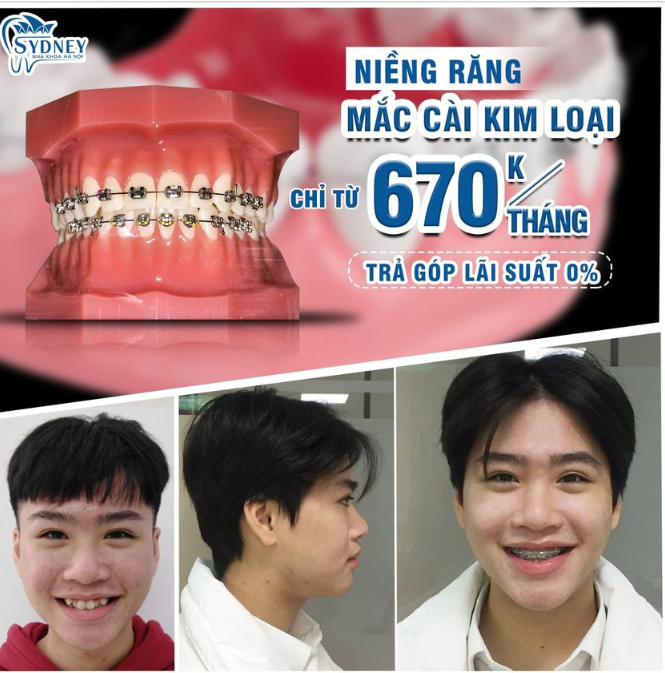 Niềng răng mắc cài kim loại – Tiết kiệm và hiệu quả