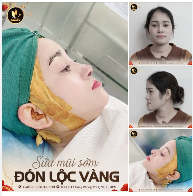 SỬA MŨI SỚM – ĐÓN LỘC VÀNG