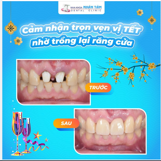 "48 Tuổi - Cảm nhận trọn vẹn vị tết nhờ trồng lại răng cửa"
