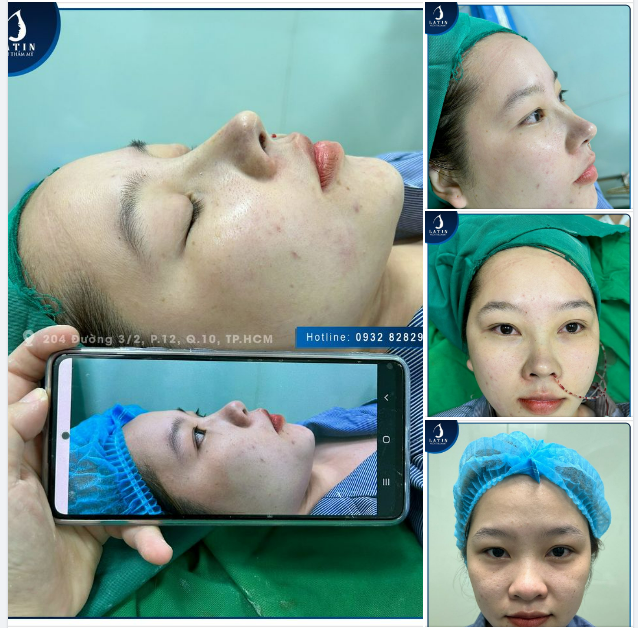 "Nâng mũi xong em thấy tự tin hơn..."