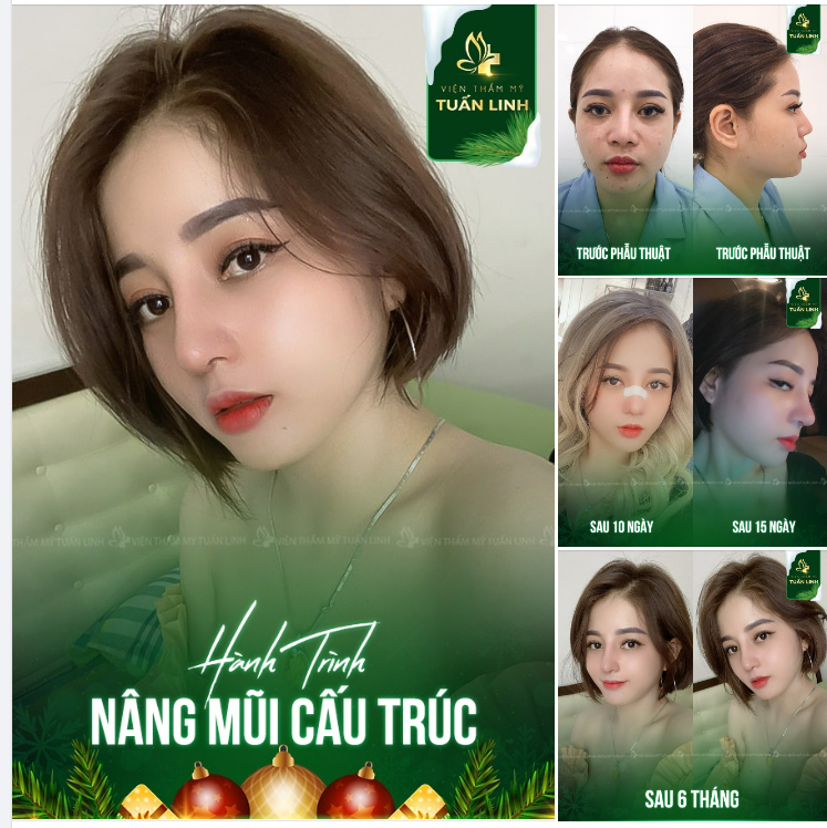 HÀNH TRÌNH NÂNG MŨI CẤU TRÚC SỬA LẠI CỦA CÔ NÀNG 9X XINH ĐẸP!!