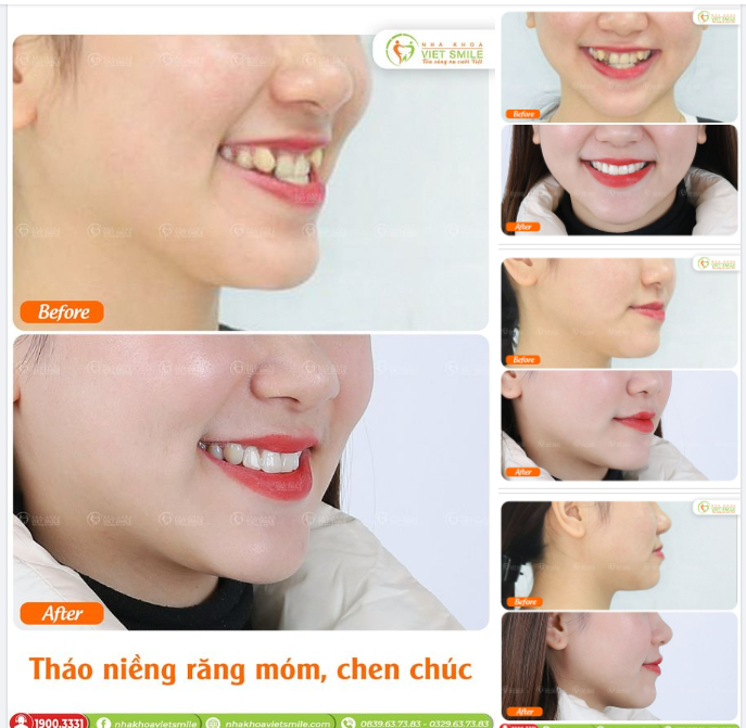 THÁO NIỀNG RĂNG MÓM, CHEN CHÚC NỤ CƯỜI TƯƠI HƠN, GÓC NGHIÊNG ĐẸP HƠN