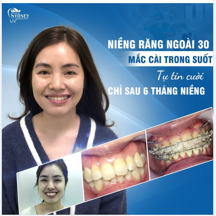 Niềng răng ngoài 30 tuổi có được không?