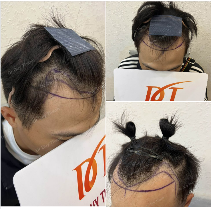 CHUẨN BỊ CẤY 1600 NANG TÓC, BOY BẮC GIANG 25 TUỔI
