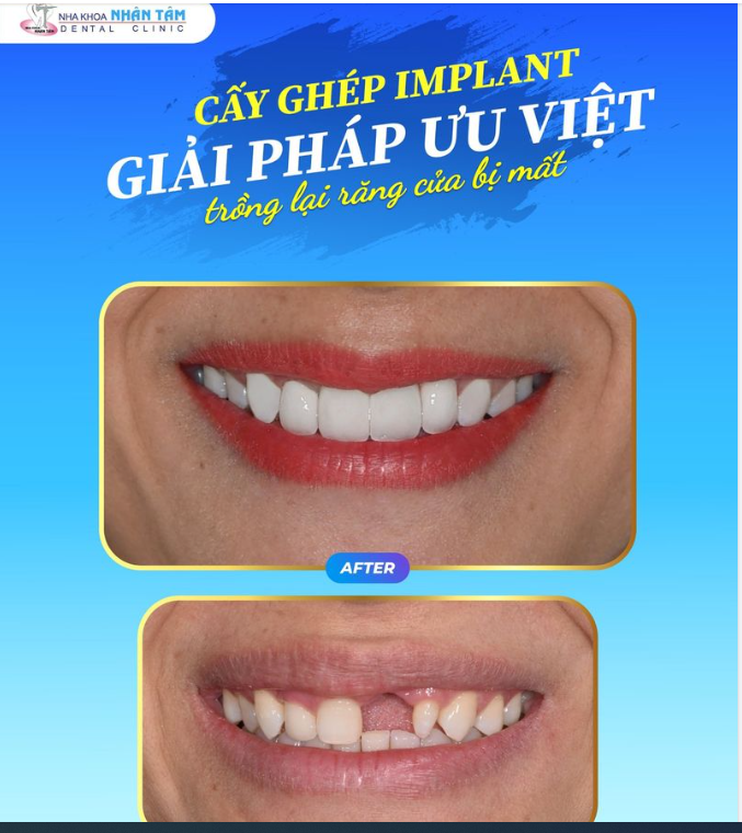 CẤY GHÉP IMPLANT - GIẢI PHÁP ƯU VIỆT TRỒNG LẠI RĂNG CỬA BỊ MẤT