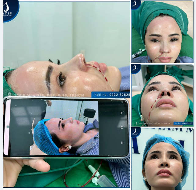 Mũi tái cấu trúc cho chị khách đã từng nâng mũi ở nơi khác nhưng không thành công