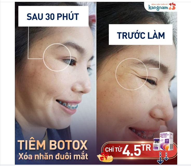 Muốn xóa nếp nhăn mắt, cau mày Tiêm botox là giải pháp nhanh nhất