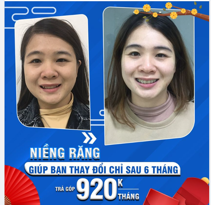Niềng răng trong suốt - Thay đổi nụ cười