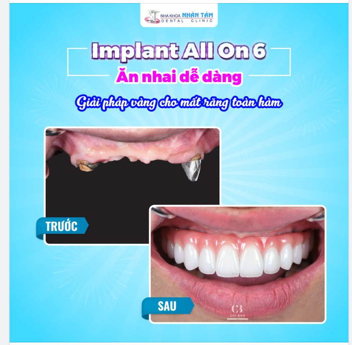 Hoàn tất xong ca cấy ghép Implant All On 6 cho cô khách dễ thương tại Nha Khoa Nhân Tâm