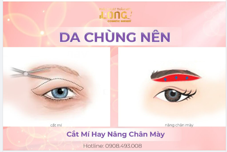 NÊN NÂNG CUNG CHÂN MÀY HAY CẮT MÍ ĐỂ KHẮC PHỤC MÍ MẮT CHẢY XỆ