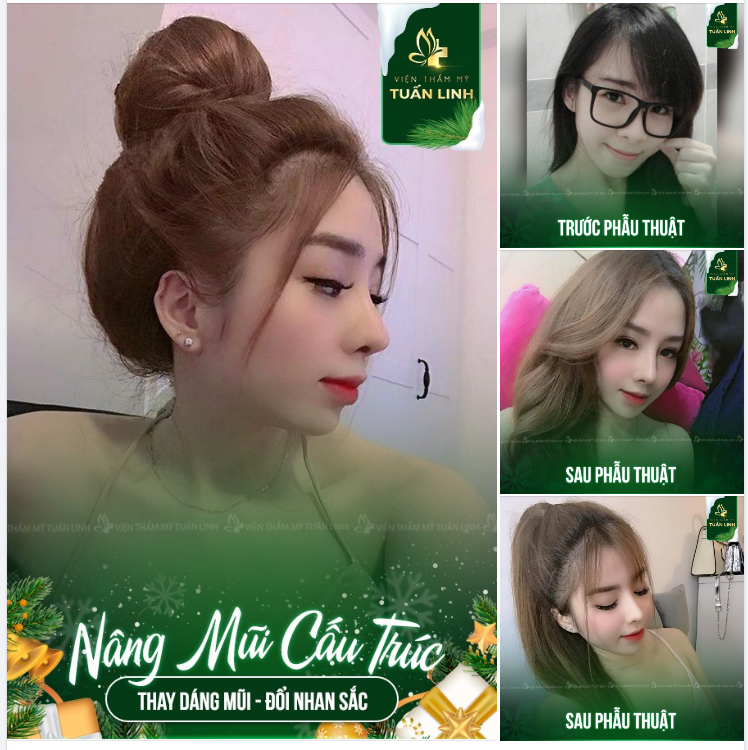 Gương mặt cân đối, xinh đẹp nổi bật sau nâng mũi cấu trúc tại Tuấn Linh!!!
