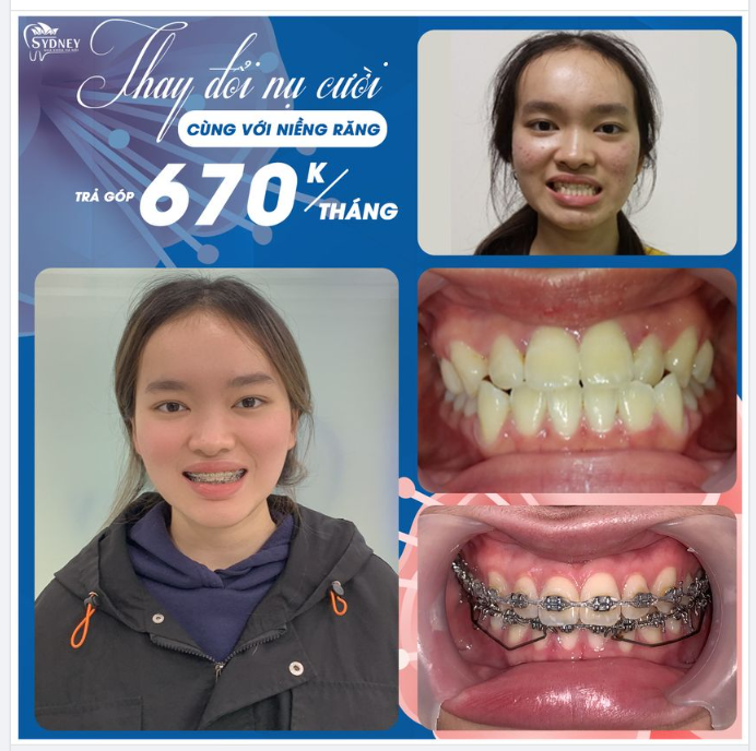 Niềng răng – Giải pháp lí tưởng khắc phục lệch khớp cắn