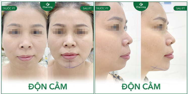 Phẫu thuật độn cằm không phải lúc nào cũng phải là cằm V-line thì mới đẹp.