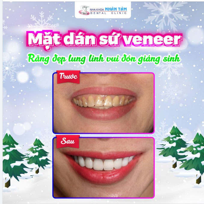 Mặt dán sứ veneer - Răng đẹp lung linh vui đón giáng sinh