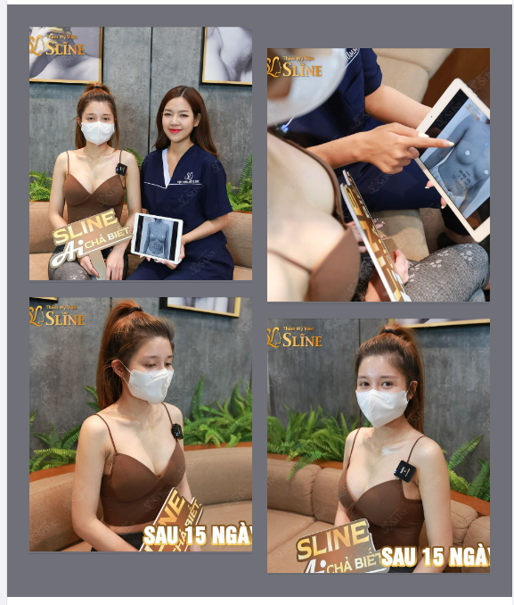 Sau 15 ngày  nâng ngực