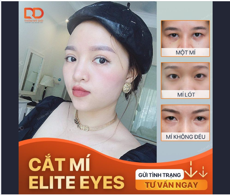 MÍ LÓT, MÍ ẨN, MÍ SỤP ​​​​​​​ 30 phút có ngay mí mắt to tròn.