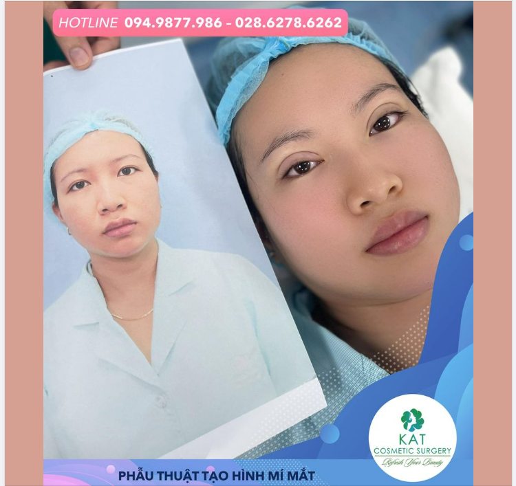 “ Giải pháp cho đôi mắt sụp mí ở người trẻ tuổi “