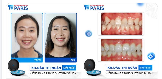Niềng răng trong suốt điều trị được mọi sai lệch răng từ dễ đến phức tạp. 