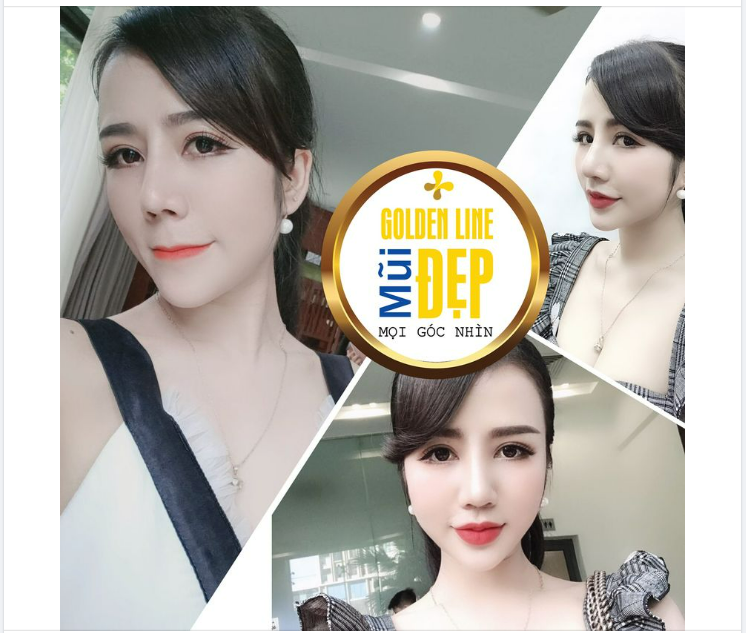 TRƯỜNG HỢP NÀO NÊN CHỌN NÂNG MŨI GOLDEN LINE ️