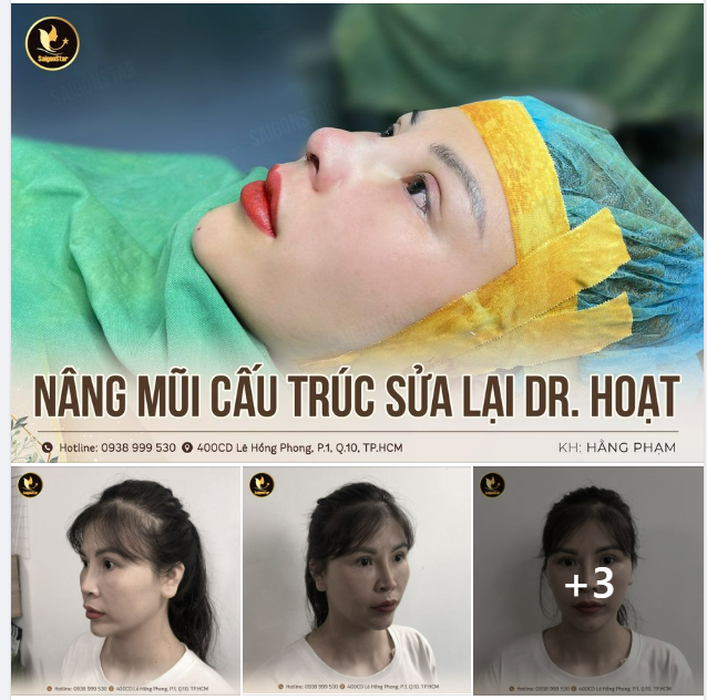 NÂNG MŨI CẤU TRÚC SỬA LẠI DR. HOẠT