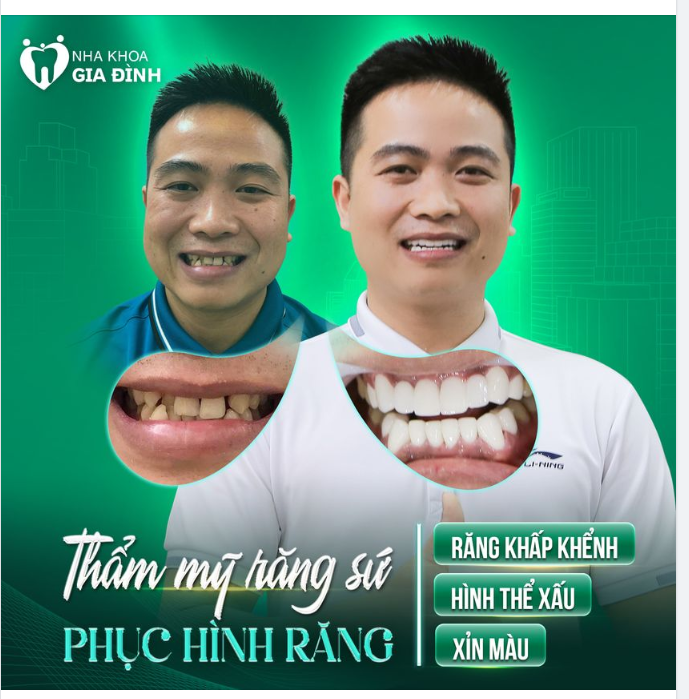 LẤY LẠI VẺ ĐẸP LỊCH LÃM SAU KHI THẨM MỸ RĂNG SỨ TẠI NHA KHOA GIA ĐÌNH