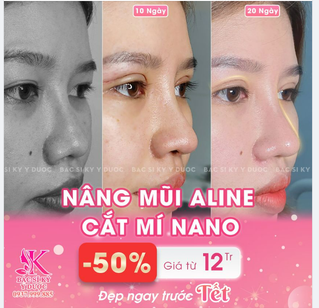 Bí quyết "Đẹp ngay trước TẾT" - Nâng mũi Aline, Cắt mí Nano giảm NGAY 50%.