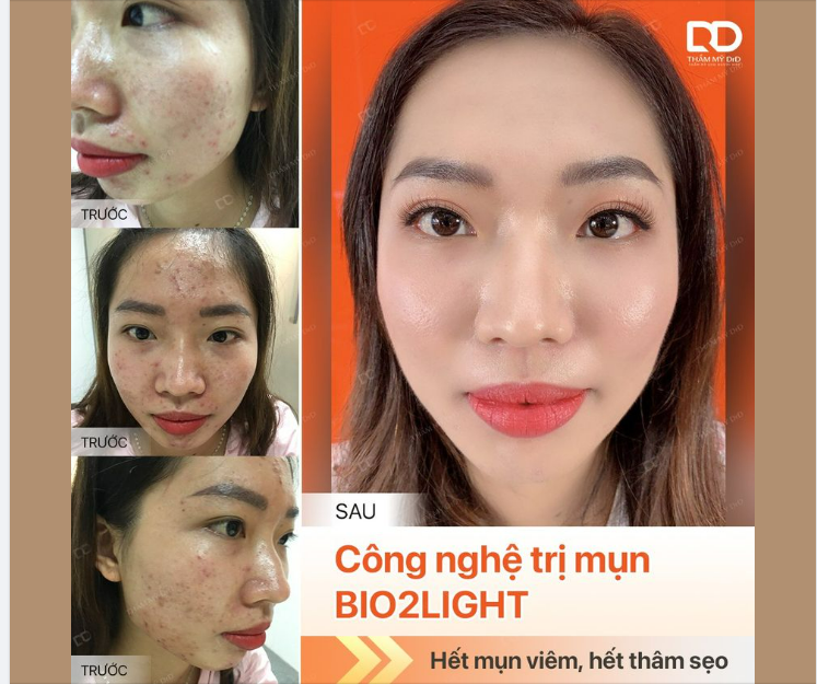 MỤN MỦ, MỤN BỌC NỔI ĐẦY MẶT PHẢI LÀM SAO?