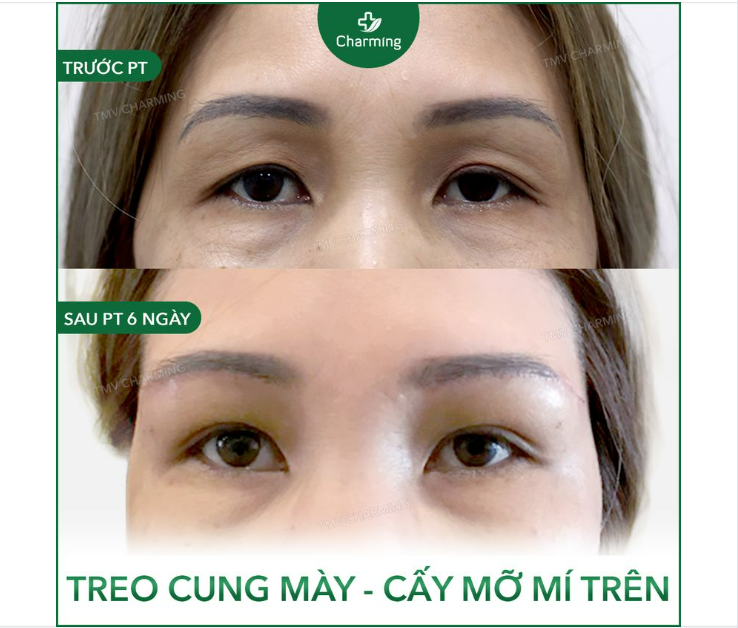 Đôi khi mắt vẫn hai mí đấy, nhưng phần đuôi mắt sụp nhẹ làm tầm nhìn và dáng mắt không được trọn vẹn.