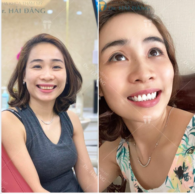 ĐỪNG ĐỂ NỤ CƯỜI HỞ LỢI KÉM DUYÊN