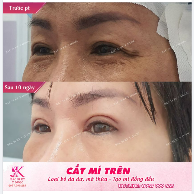 Đôi mắt đẹp hút hồn - Tạo mắt 2 mí đẹp tự nhiên