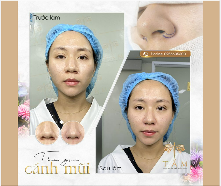 Giải pháp xử lý khuyết điểm cánh mũi thô, to