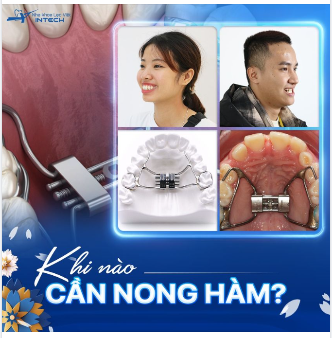 TRƯỜNG HỢP NÀO CẦN NONG HÀM KHI NIỀNG RĂNG?