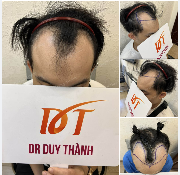 CHUẨN BỊ CẤY 1800 NANG BOY HÀ ĐÔNG 29 TUỔI